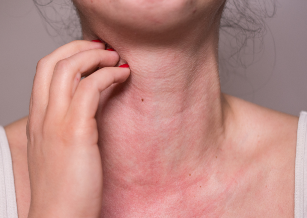 Close-up of a person scratching their neck with visible red rash, potentially from an allergic reaction, emphasizing the importance of non-toxic products for sensitive skin.